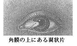 角膜の上にある翼状片