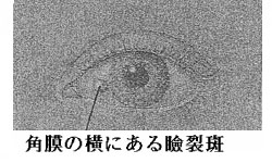 角膜の横にある瞼裂斑