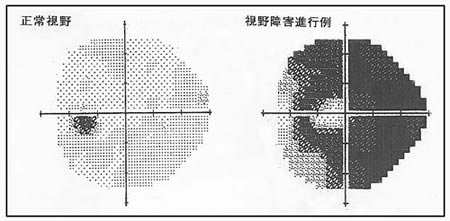 irfig1
